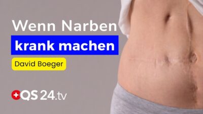 Mehr über den Artikel erfahren Von der Narbe zur Krankheit: Was Kaiserschnitt-Narben im Körper anrichten können | QS24