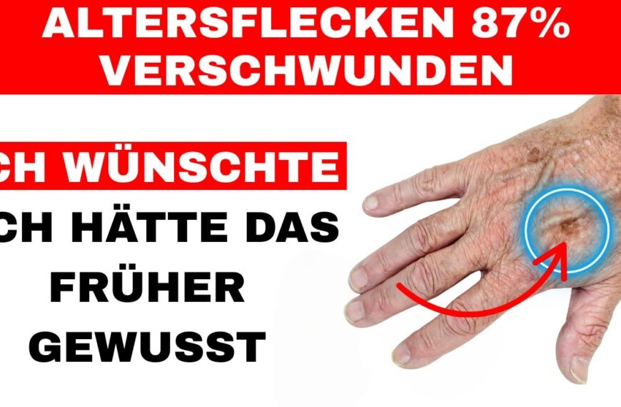 Altersflecken mit diesen Tricks sofort verschwinden lassen (Unglaublich effektiv)