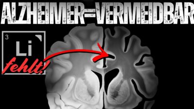 Mehr über den Artikel erfahren Alzheimer vermeiden – warum Lithium der Schlüssel ist